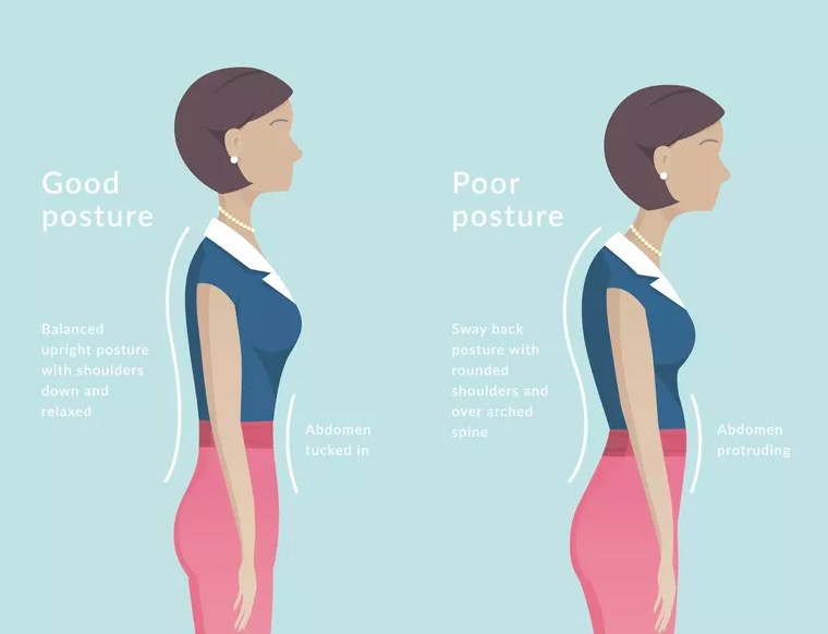 Sway Back Posture - Physiopedia